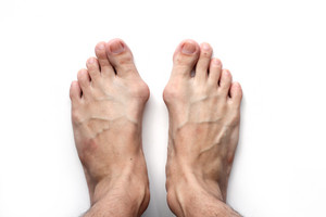 Was tun bei Hallux Valgus? 